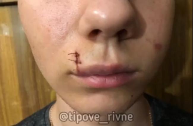 Ви зараз переглядаєте Бійка підлітків у Рівному: рідні побитого хлопця просять відгукнутися (ВІДЕО)